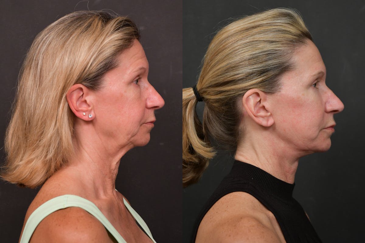Changes Deep Plane Face Lift  Before & After Gallery - Patient 305415 - Image 4