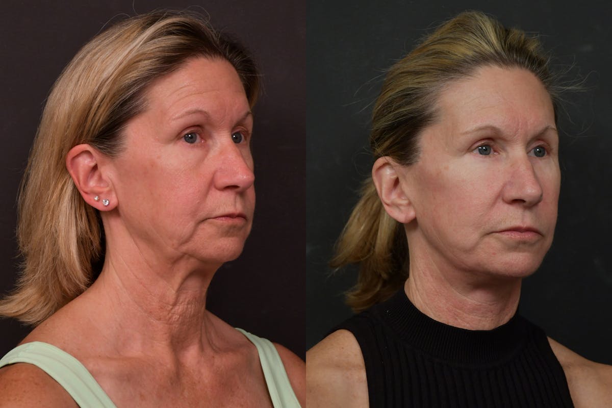 Changes Deep Plane Face Lift  Before & After Gallery - Patient 305415 - Image 3