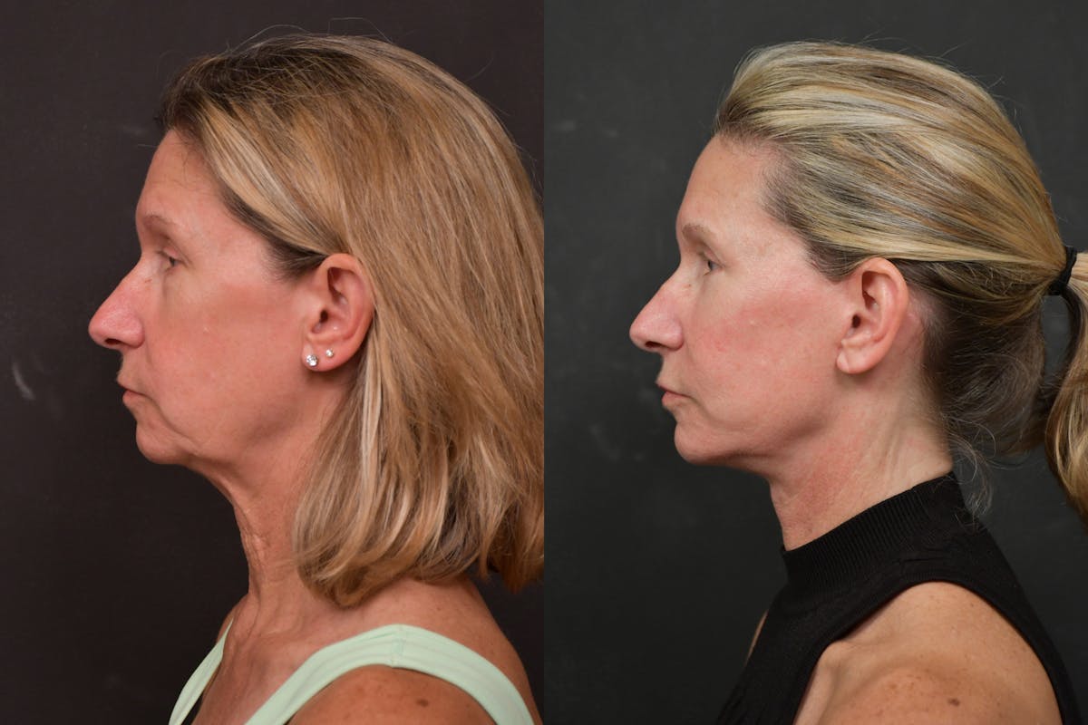 Changes Deep Plane Face Lift  Before & After Gallery - Patient 305415 - Image 2