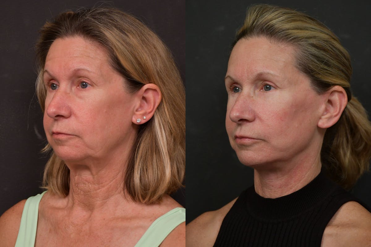 Changes Deep Plane Face Lift  Before & After Gallery - Patient 305415 - Image 1