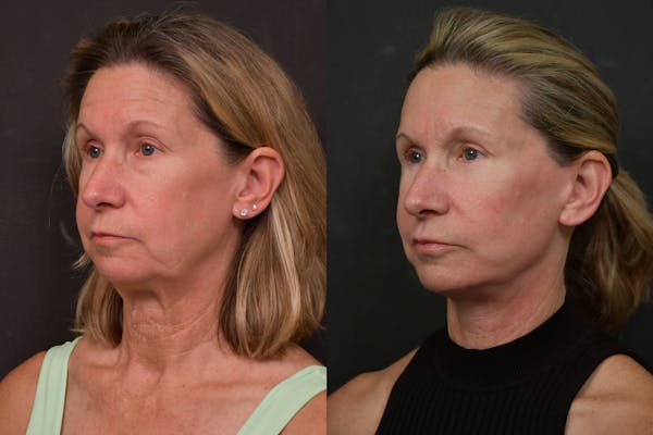 Changes Deep Plane Face Lift  Before & After Gallery - Patient 305415 - Image 1