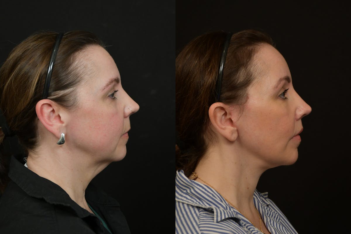Changes Deep Plane Face Lift  Before & After Gallery - Patient 130363 - Image 4