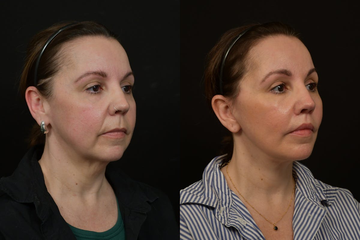Changes Deep Plane Face Lift  Before & After Gallery - Patient 130363 - Image 3