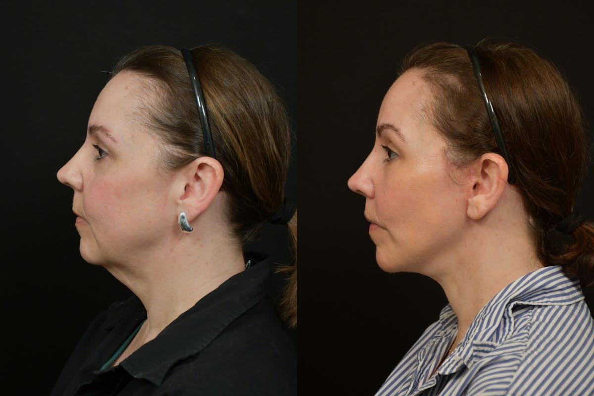 Changes Deep Plane Face Lift  Before & After Gallery - Patient 130363 - Image 2
