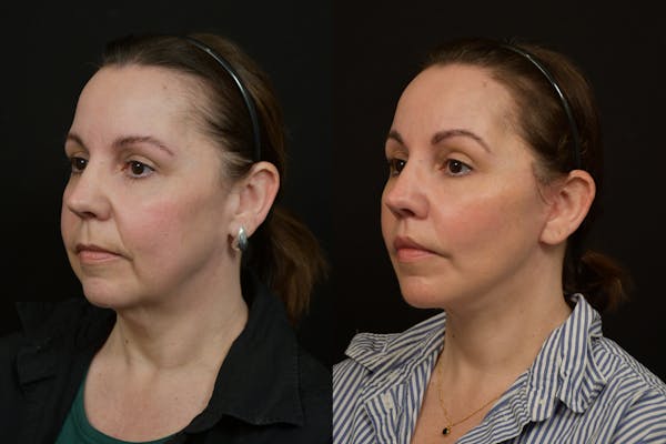 Changes Deep Plane Face Lift  Before & After Gallery - Patient 130363 - Image 1