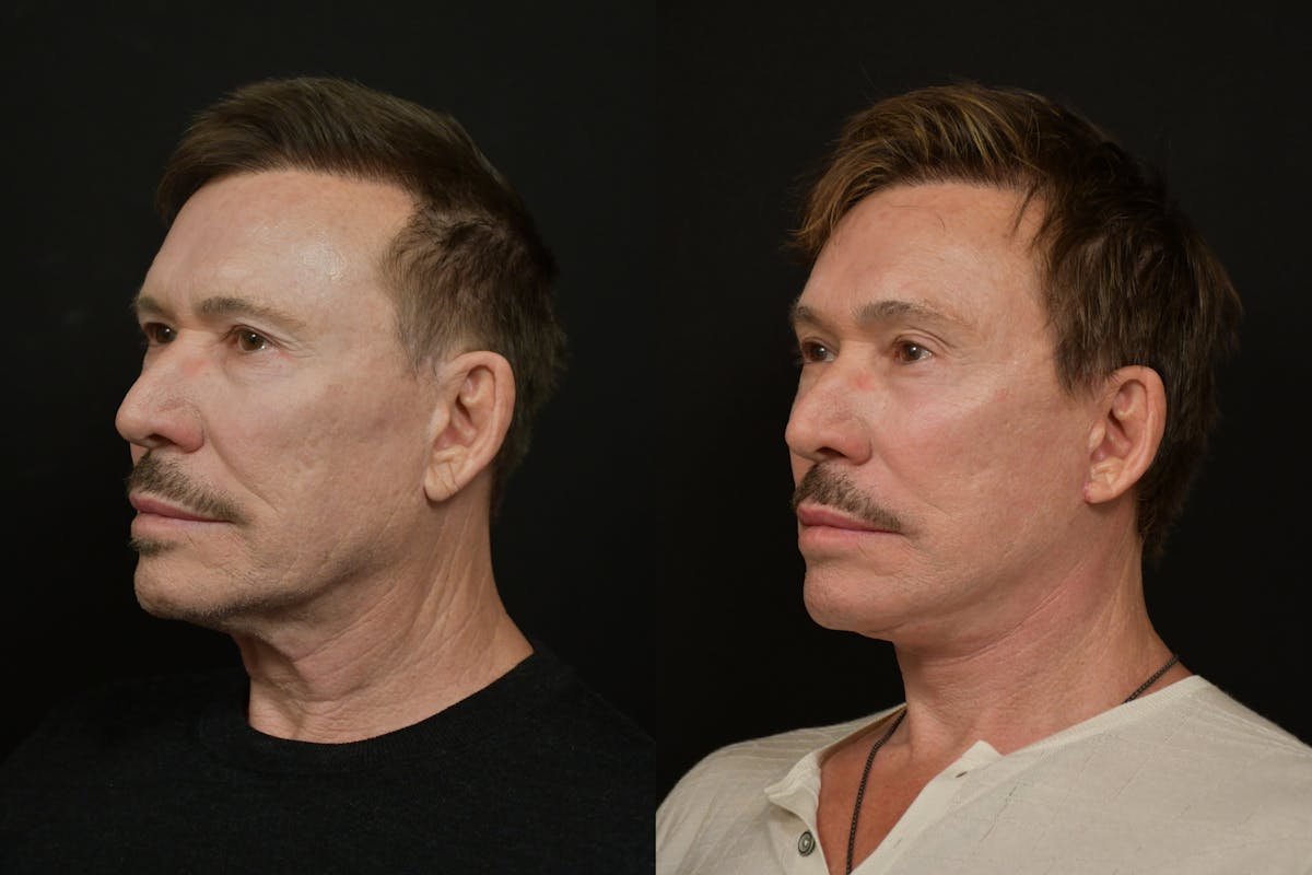Changes Deep Plane Face Lift  Before & After Gallery - Patient 671414 - Image 1