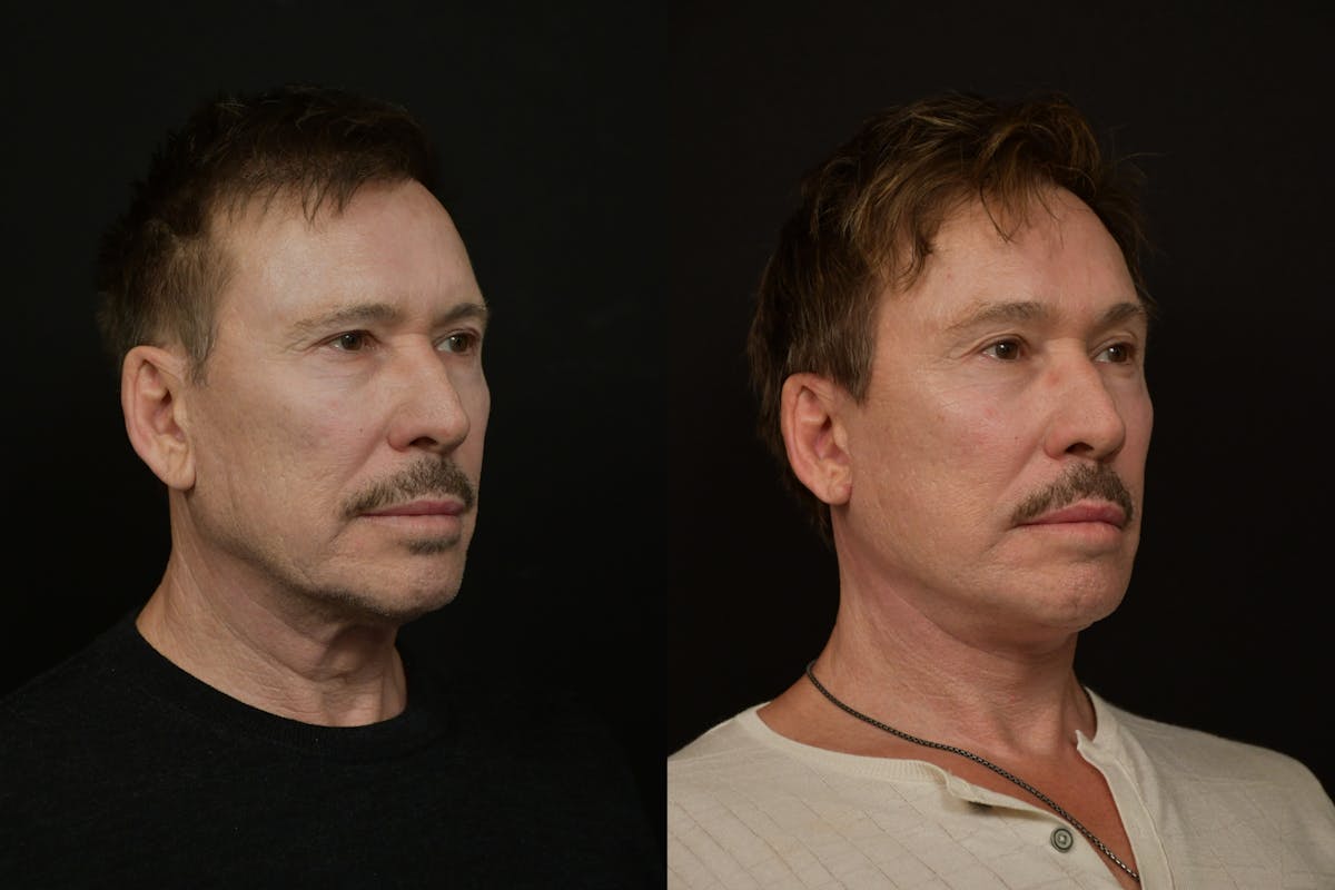 Changes Deep Plane Face Lift  Before & After Gallery - Patient 671414 - Image 3