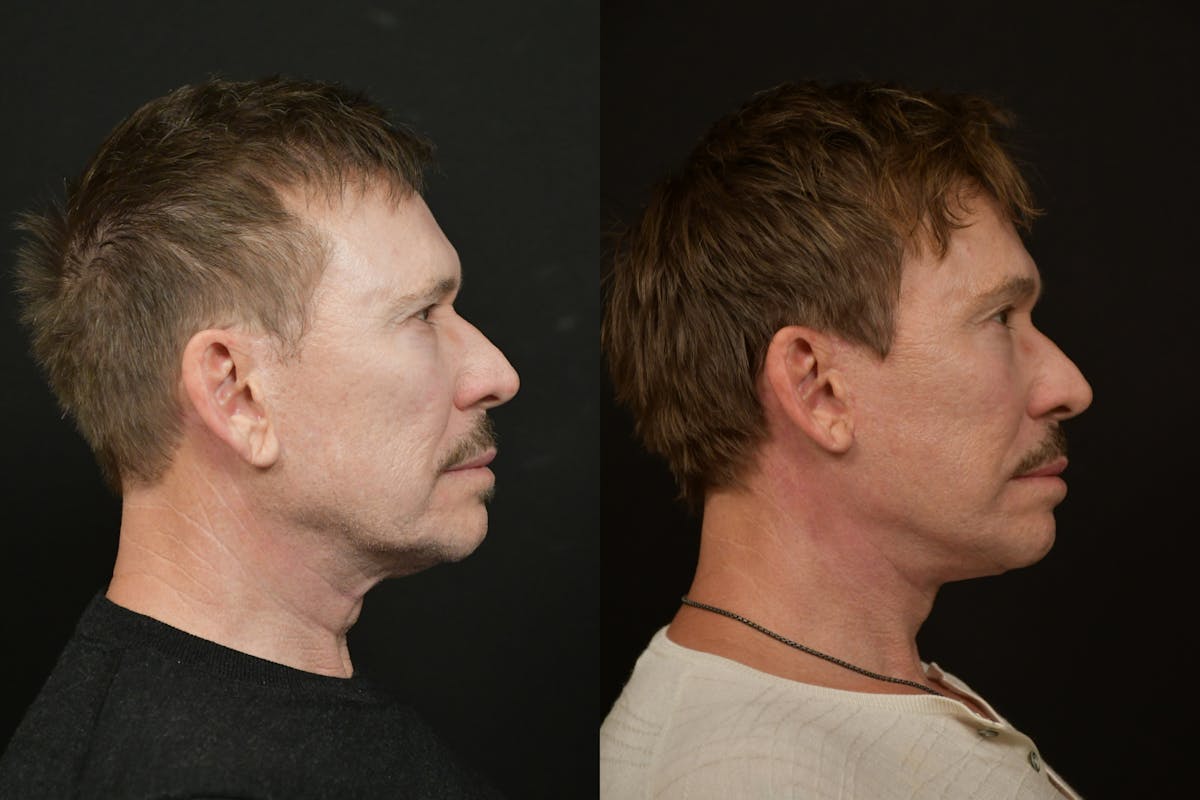 Changes Deep Plane Face Lift  Before & After Gallery - Patient 671414 - Image 4