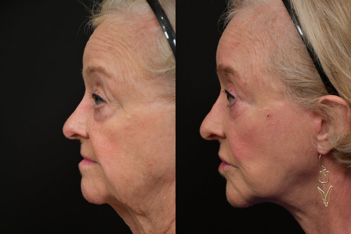 Neck Lift Before & After Gallery - Patient 313717 - Image 2