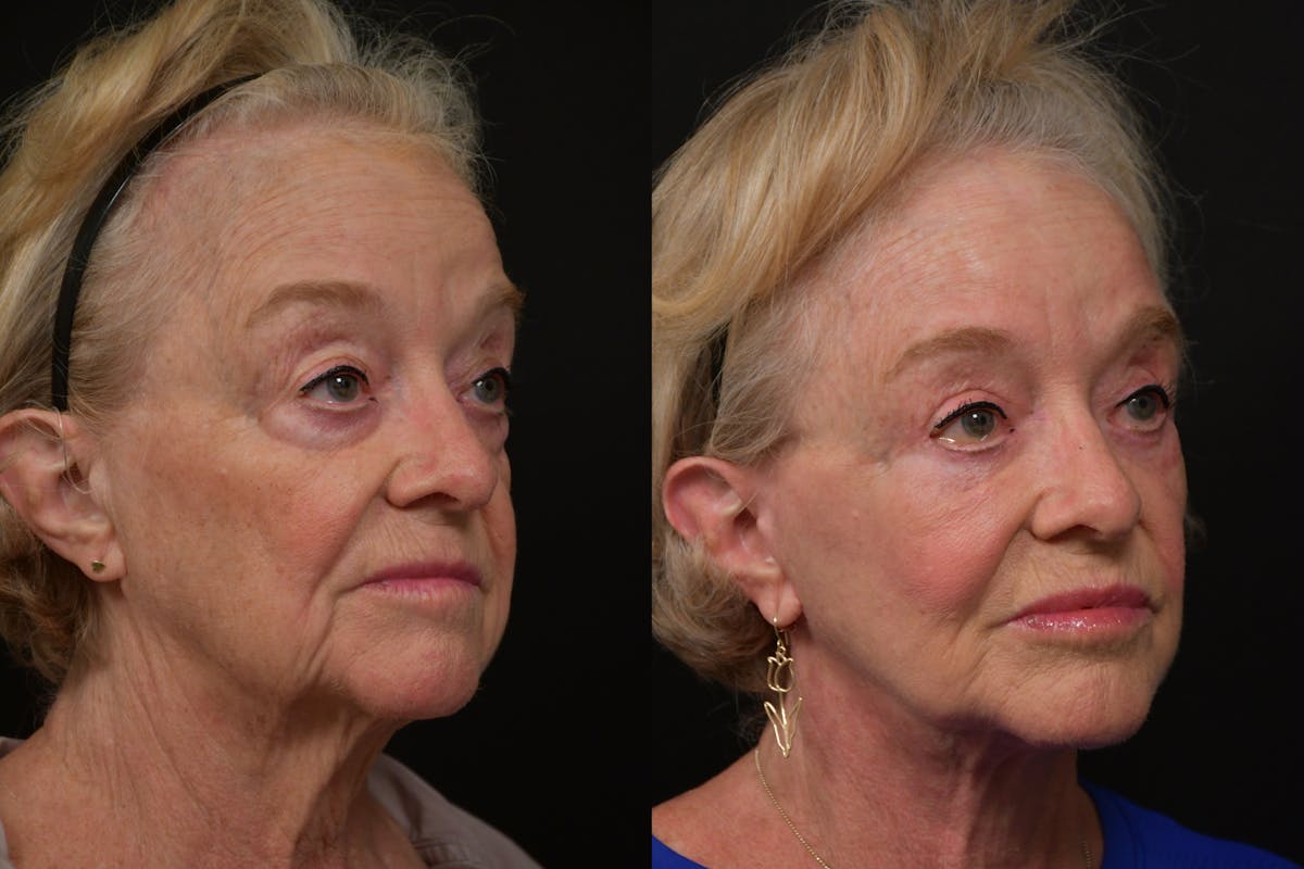 Neck Lift Before & After Gallery - Patient 313717 - Image 3