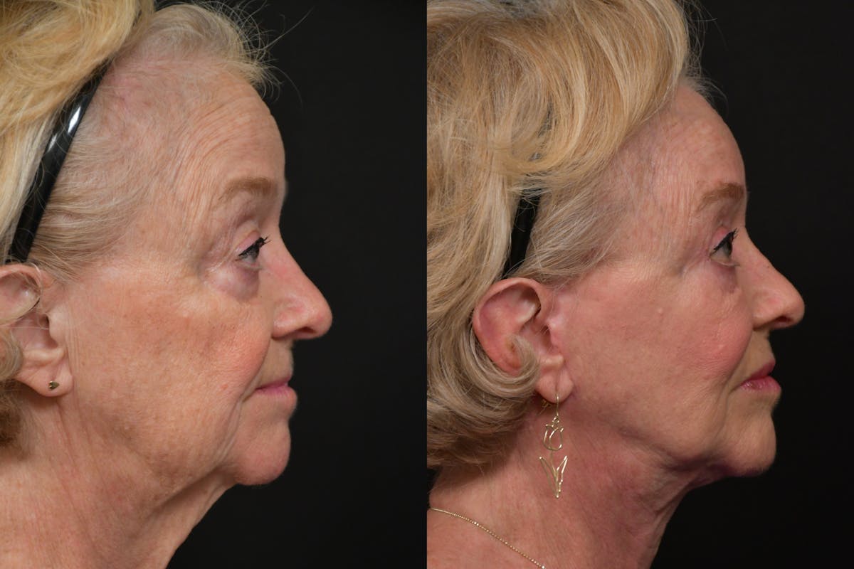 Neck Lift Before & After Gallery - Patient 313717 - Image 4