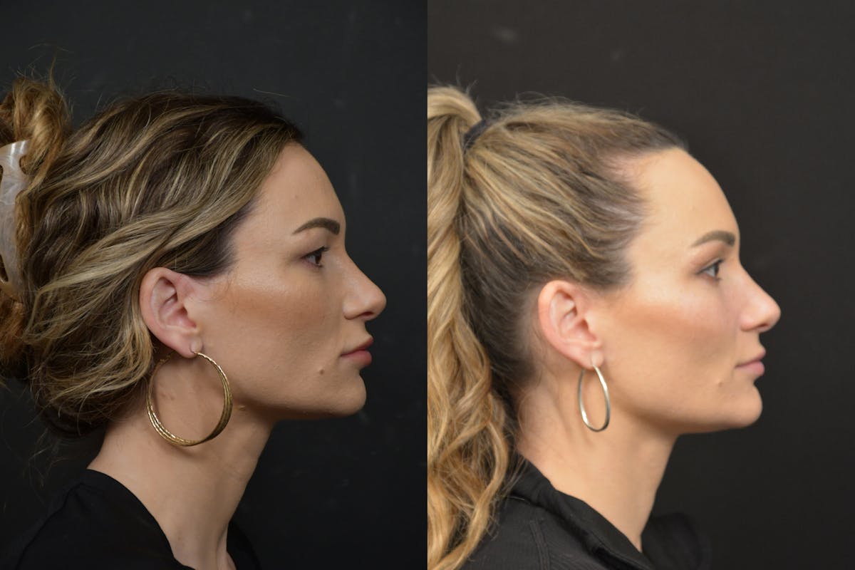 Jawline/Chin Before & After Gallery - Patient 270105 - Image 5
