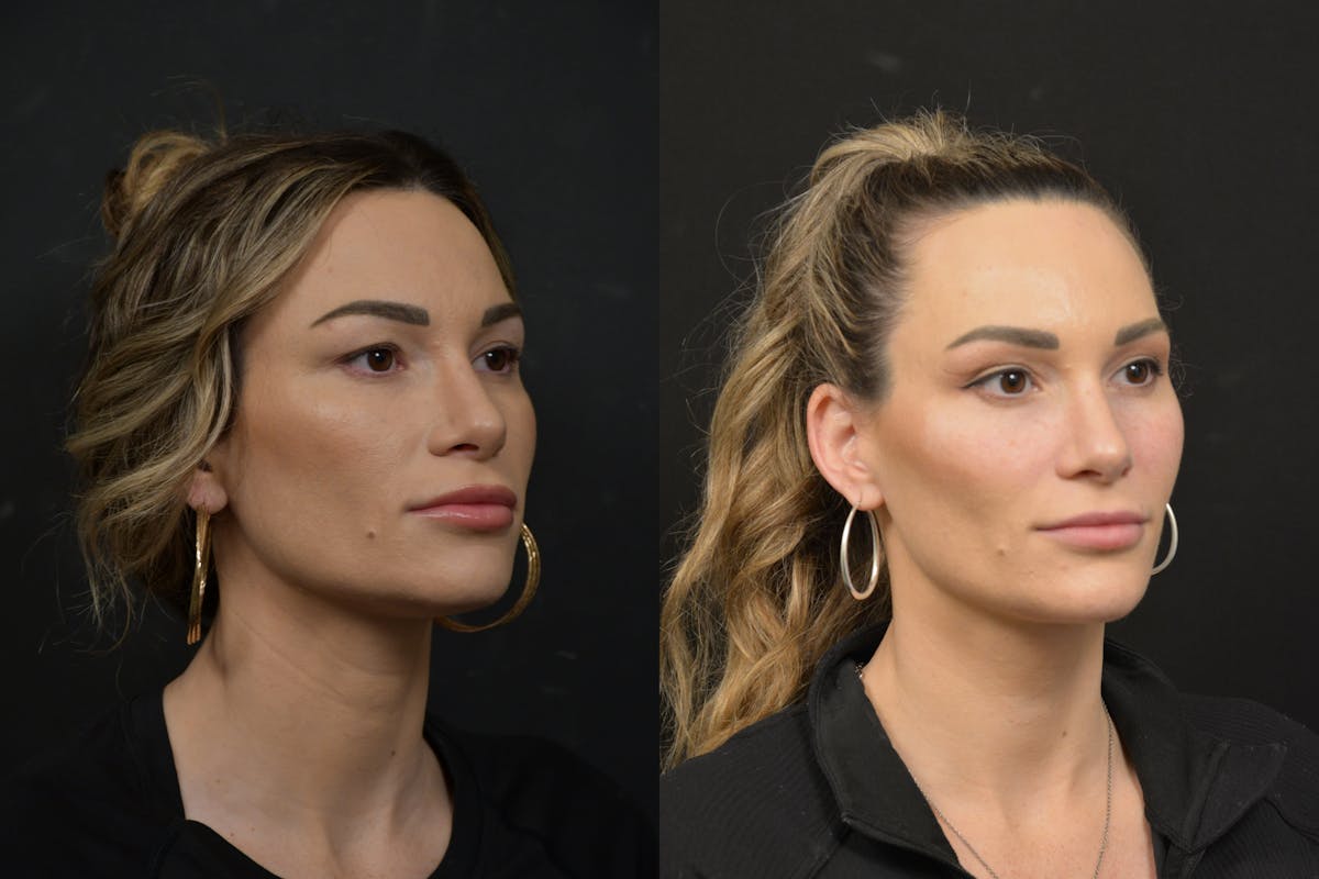 Jawline/Chin Before & After Gallery - Patient 270105 - Image 4