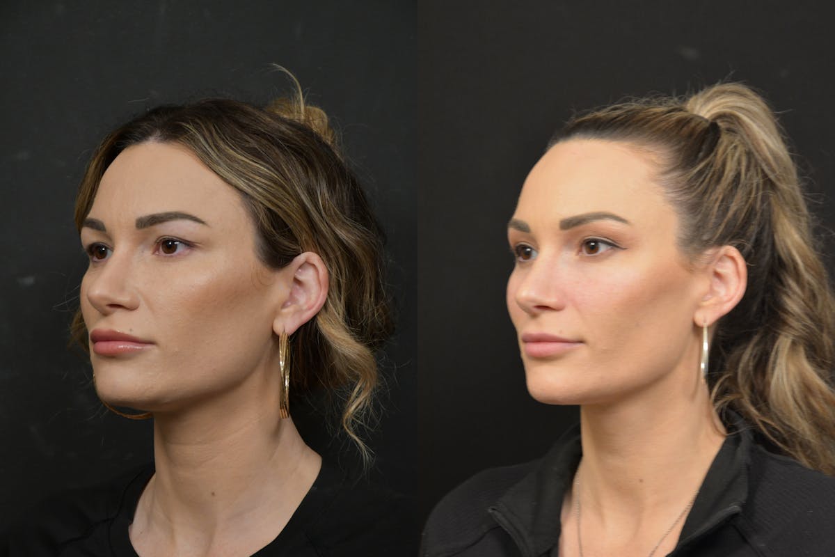Jawline/Chin Before & After Gallery - Patient 270105 - Image 6