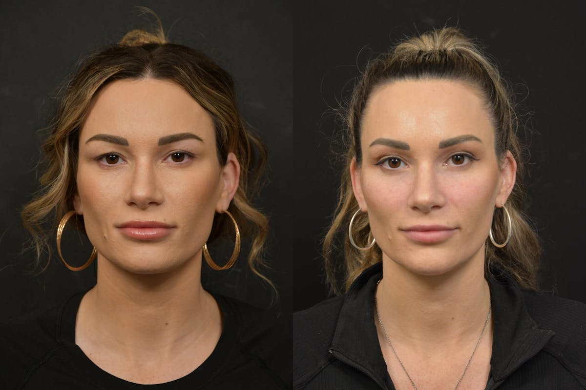 Jawline/Chin Before & After Gallery - Patient 270105 - Image 1