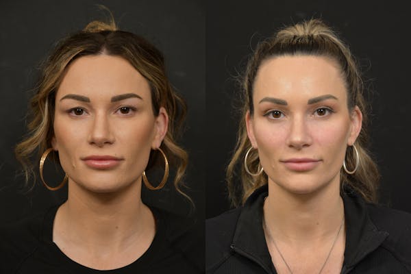 Eyelid Surgery Before & After Gallery - Patient 938526 - Image 1