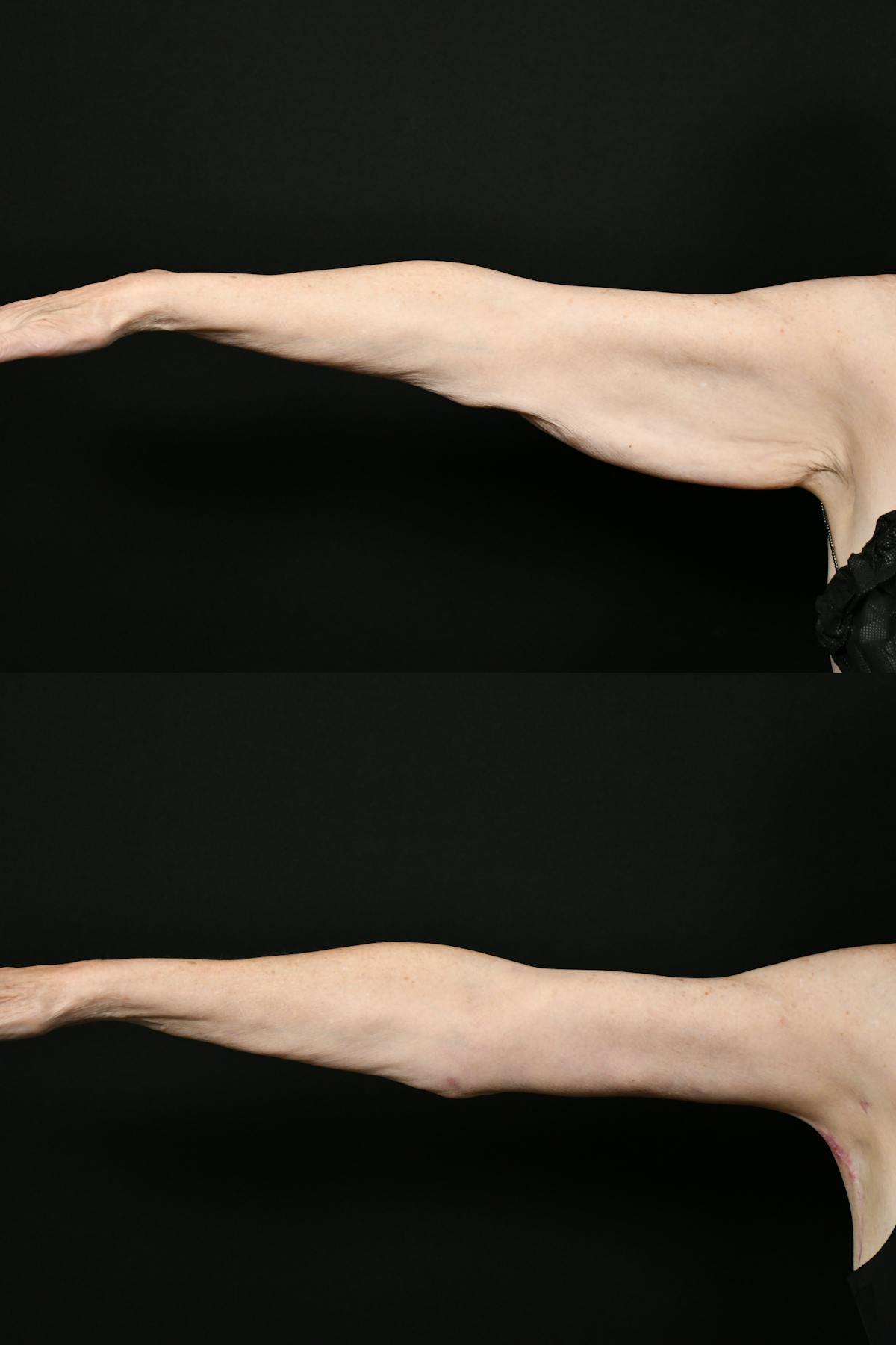 Arm Lift Before & After Gallery - Patient 277337 - Image 11