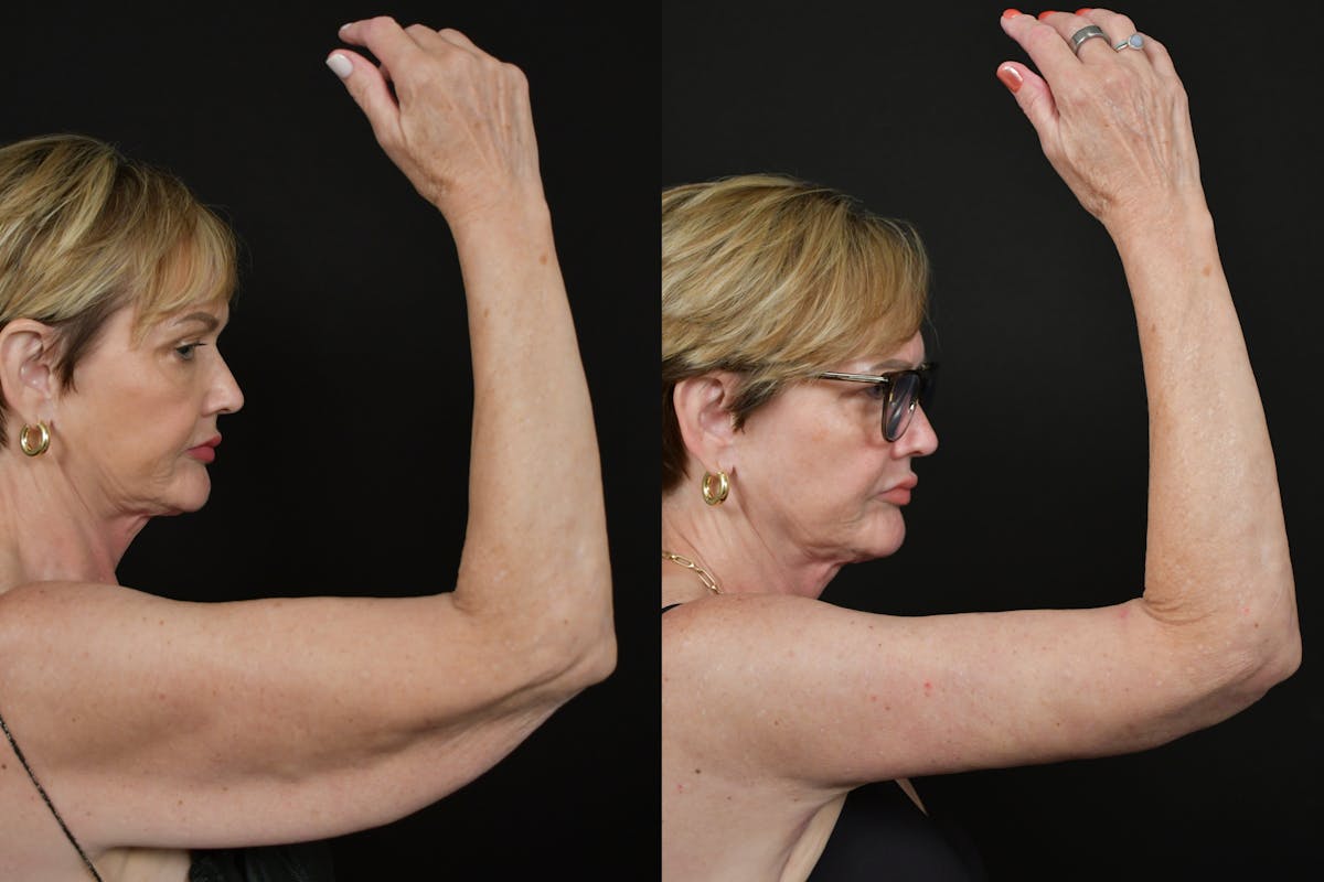 Arm Lift Before & After Gallery - Patient 277337 - Image 12