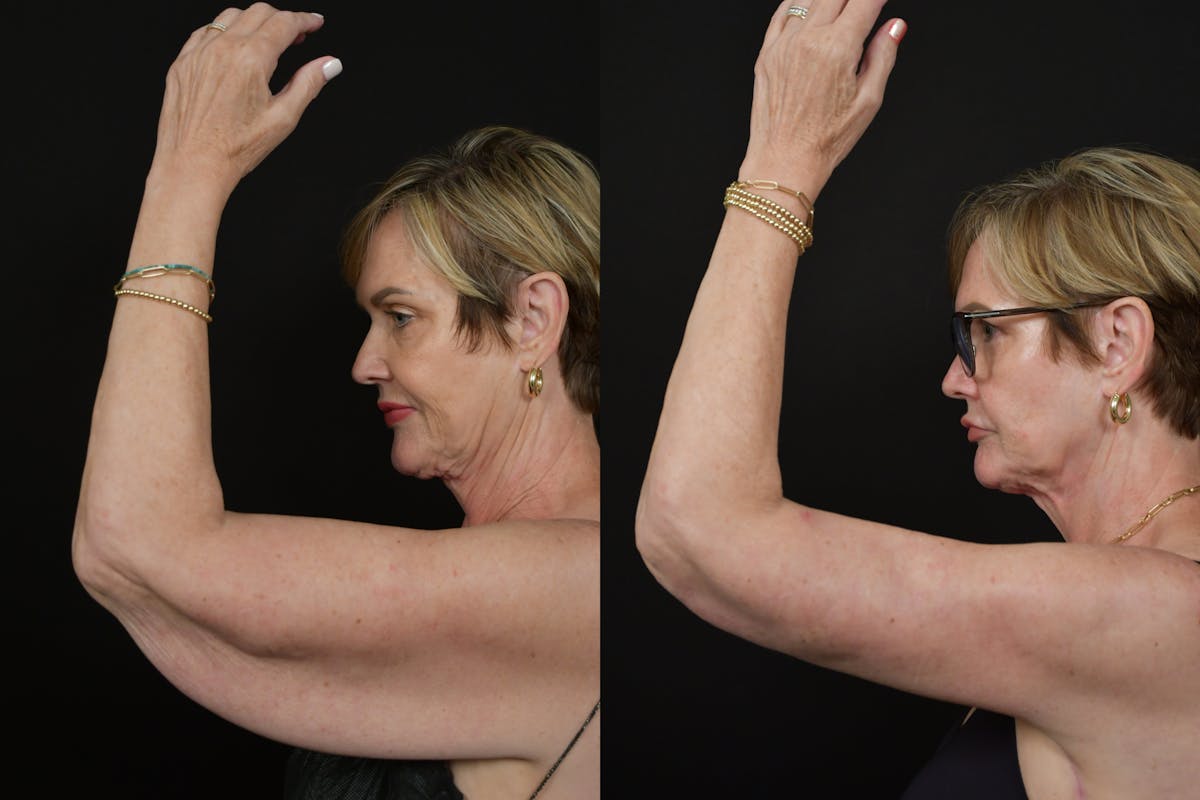 Arm Lift Before & After Gallery - Patient 277337 - Image 10