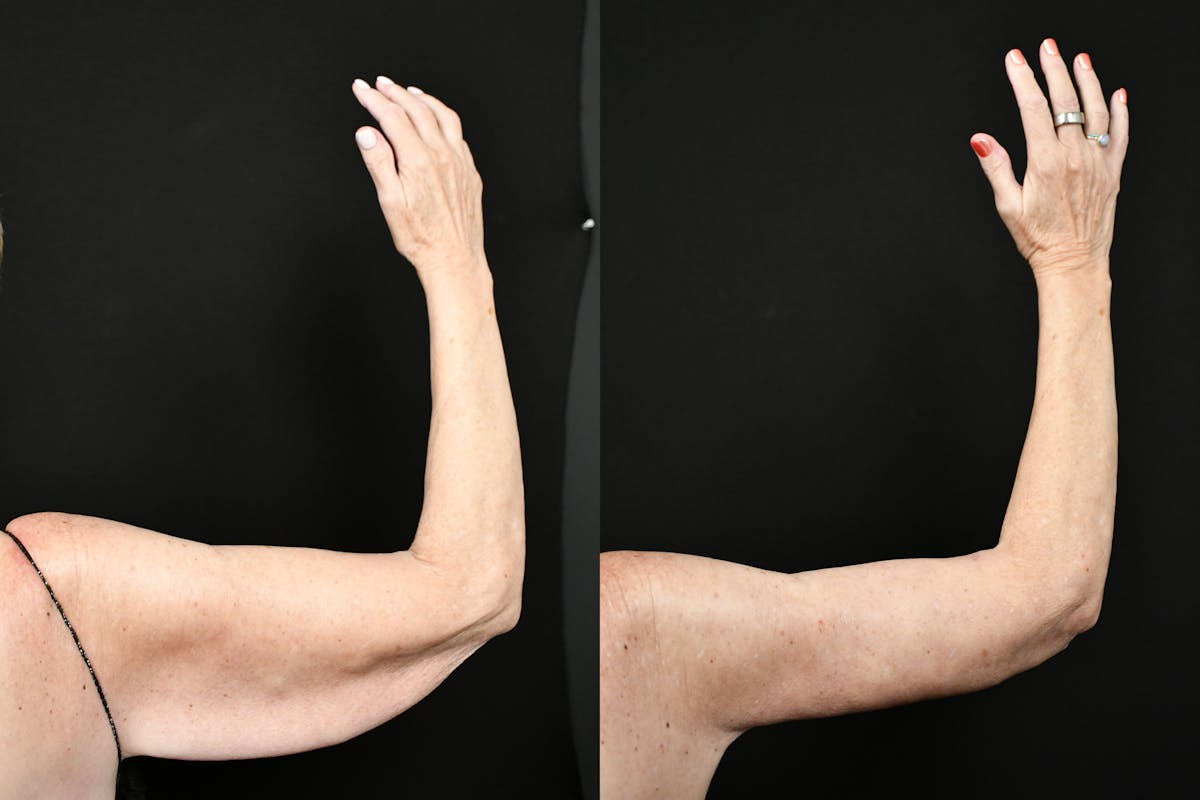 Arm Lift Before & After Gallery - Patient 277337 - Image 6