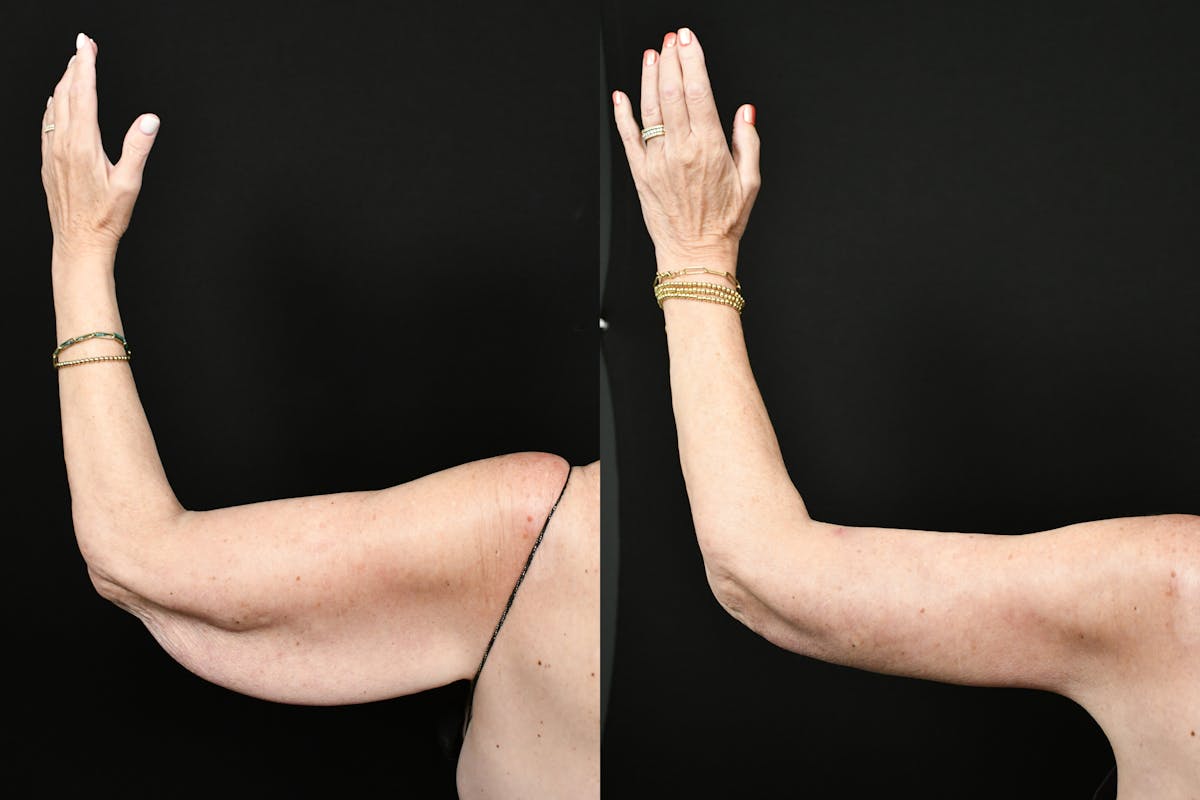 Arm Lift Before & After Gallery - Patient 277337 - Image 14