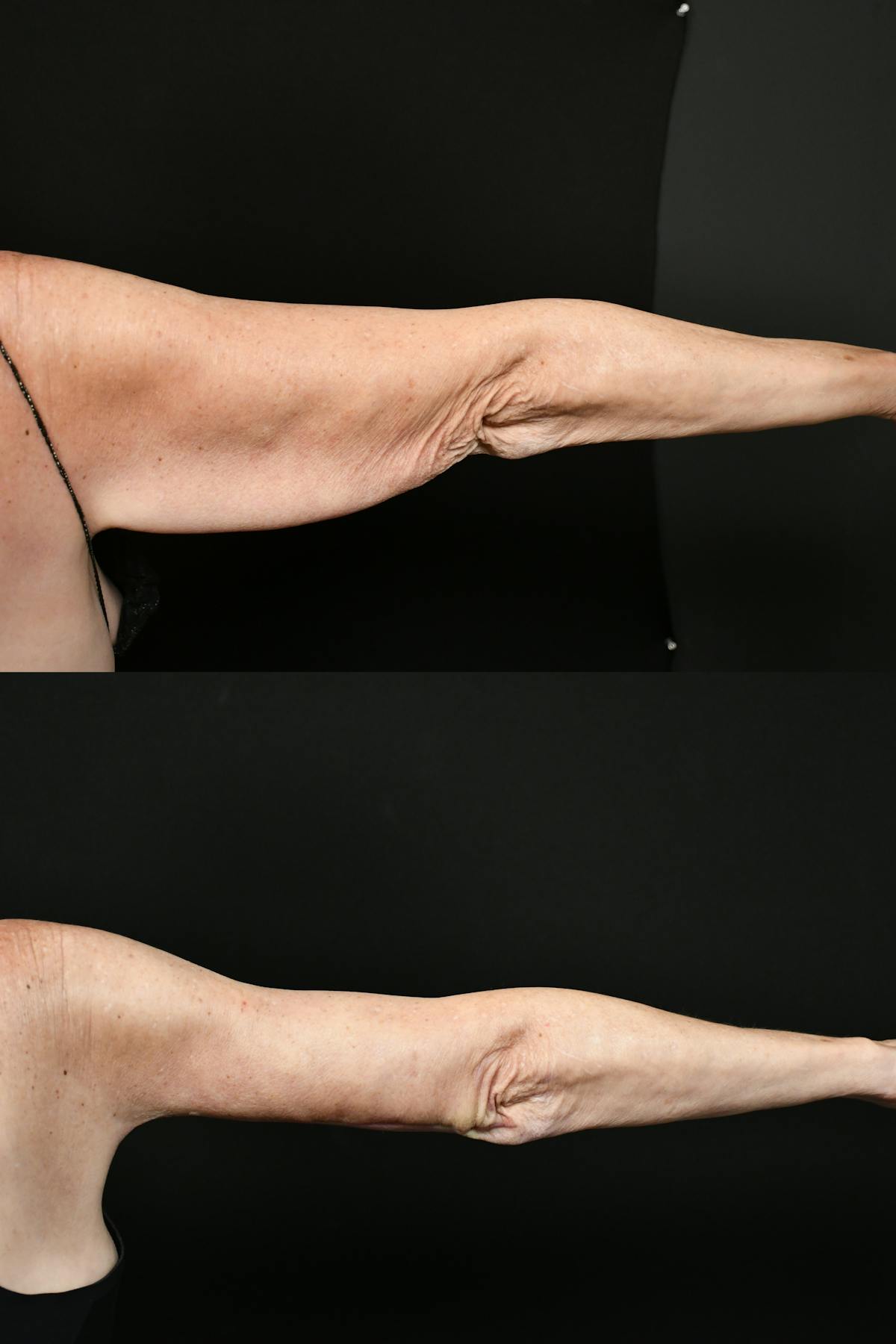 Arm Lift Before & After Gallery - Patient 277337 - Image 9