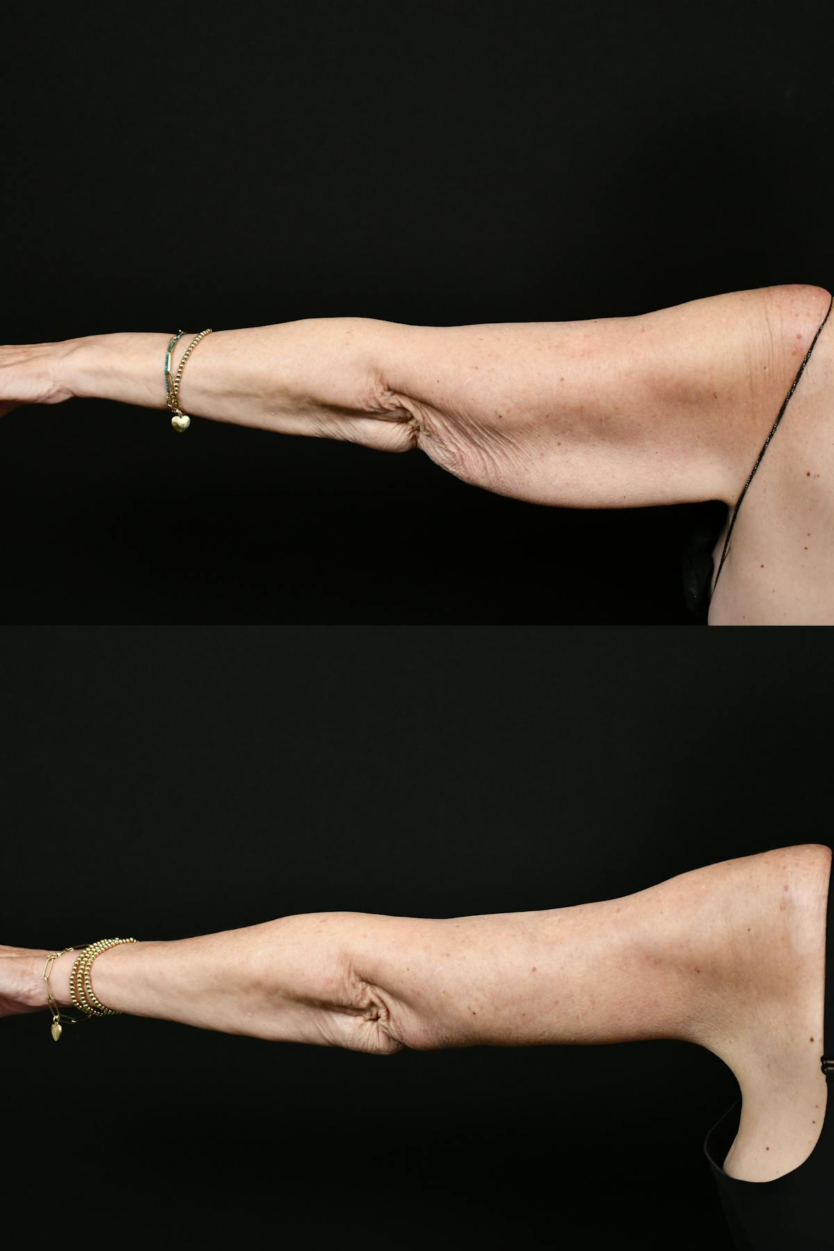 Arm Lift Before & After Gallery - Patient 277337 - Image 5