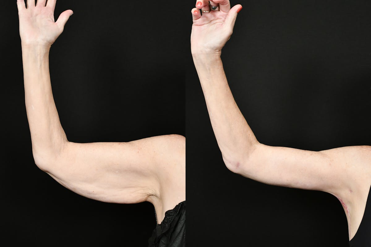Arm Lift Before & After Gallery - Patient 277337 - Image 13