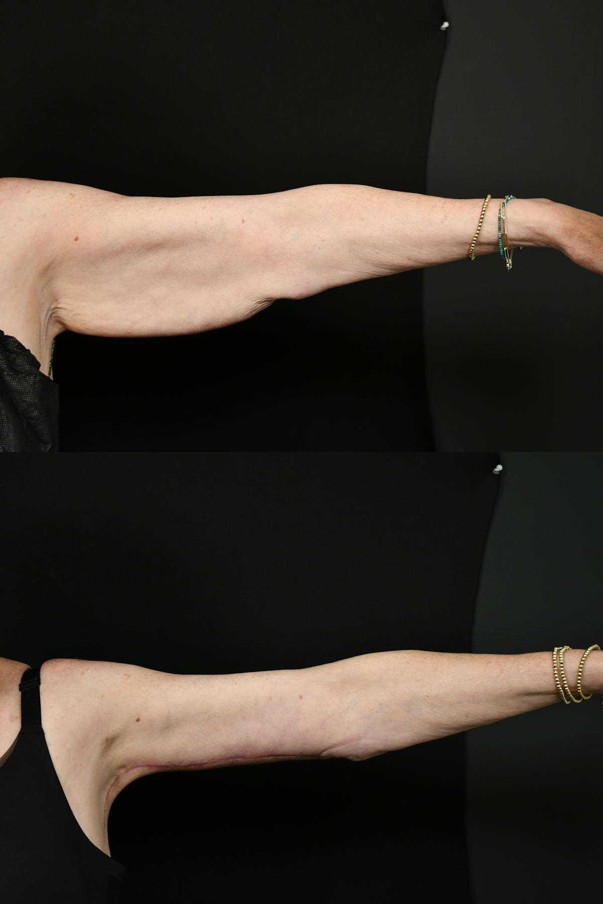 Arm Lift Before & After Gallery - Patient 277337 - Image 7