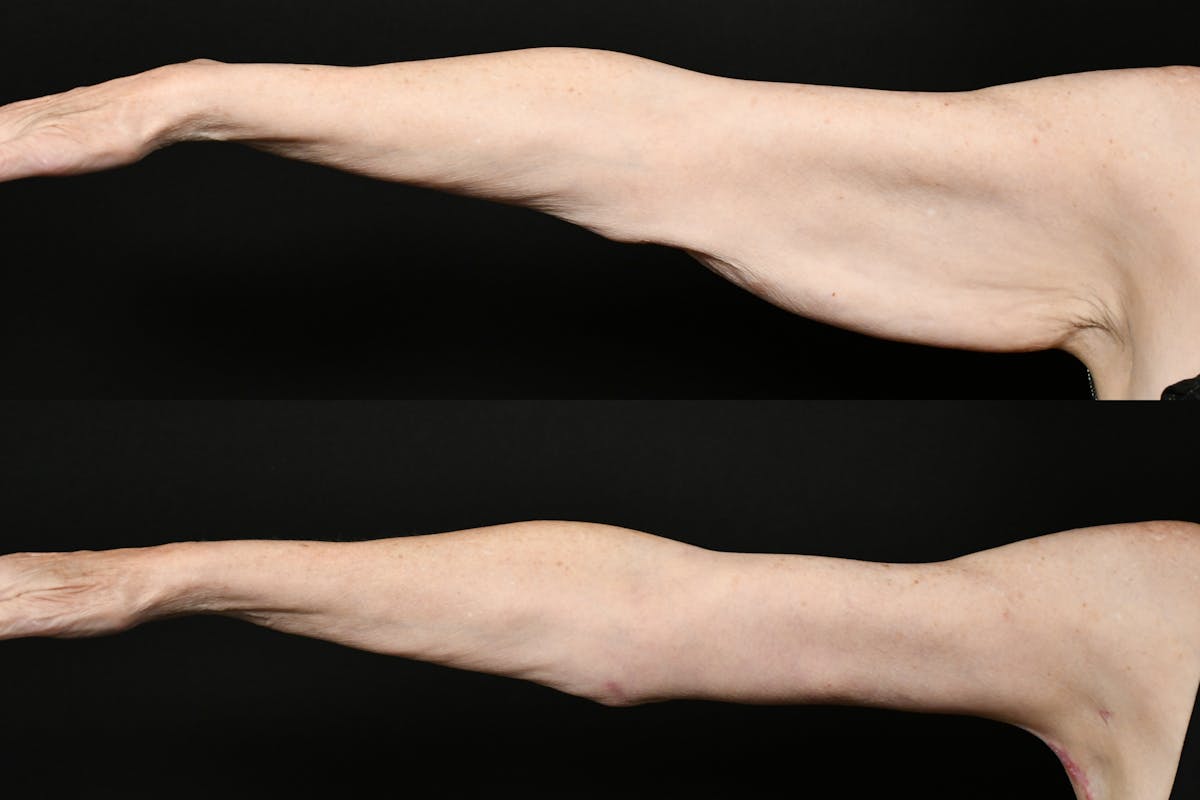 Arm Lift Before & After Gallery - Patient 277337 - Image 3