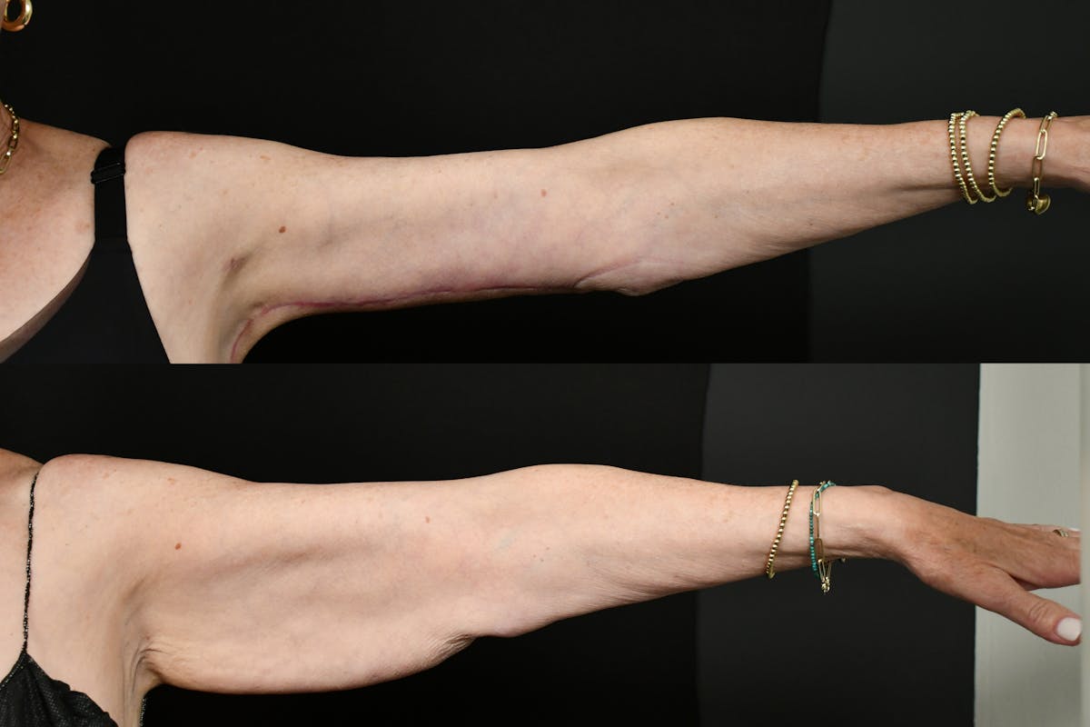 Arm Lift Before & After Gallery - Patient 277337 - Image 2
