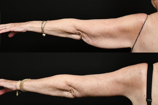 Arm Lift Before & After Gallery - Patient 277337 - Image 1
