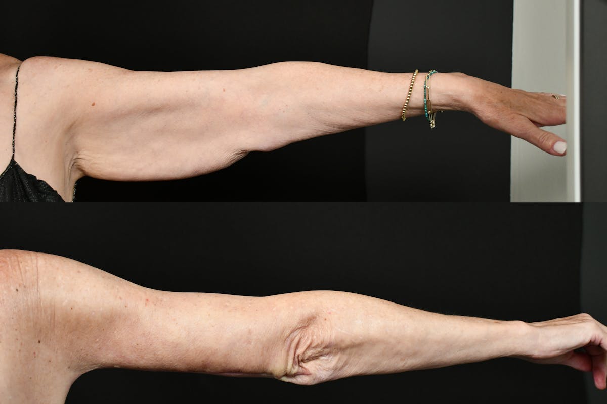 Arm Lift Before & After Gallery - Patient 277337 - Image 4