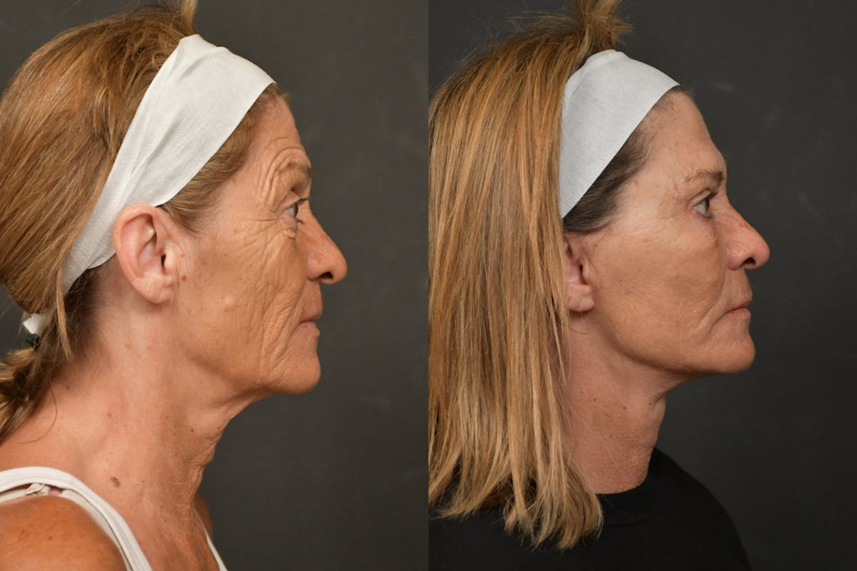 Eyelid Surgery Before & After Gallery - Patient 267852 - Image 5