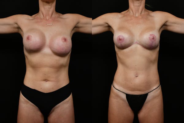 Mommy Makeover Before & After Gallery - Patient 414337 - Image 1