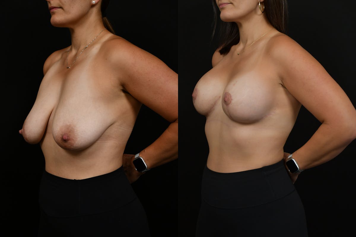 Breast Lift Before & After Gallery - Patient 182455 - Image 4