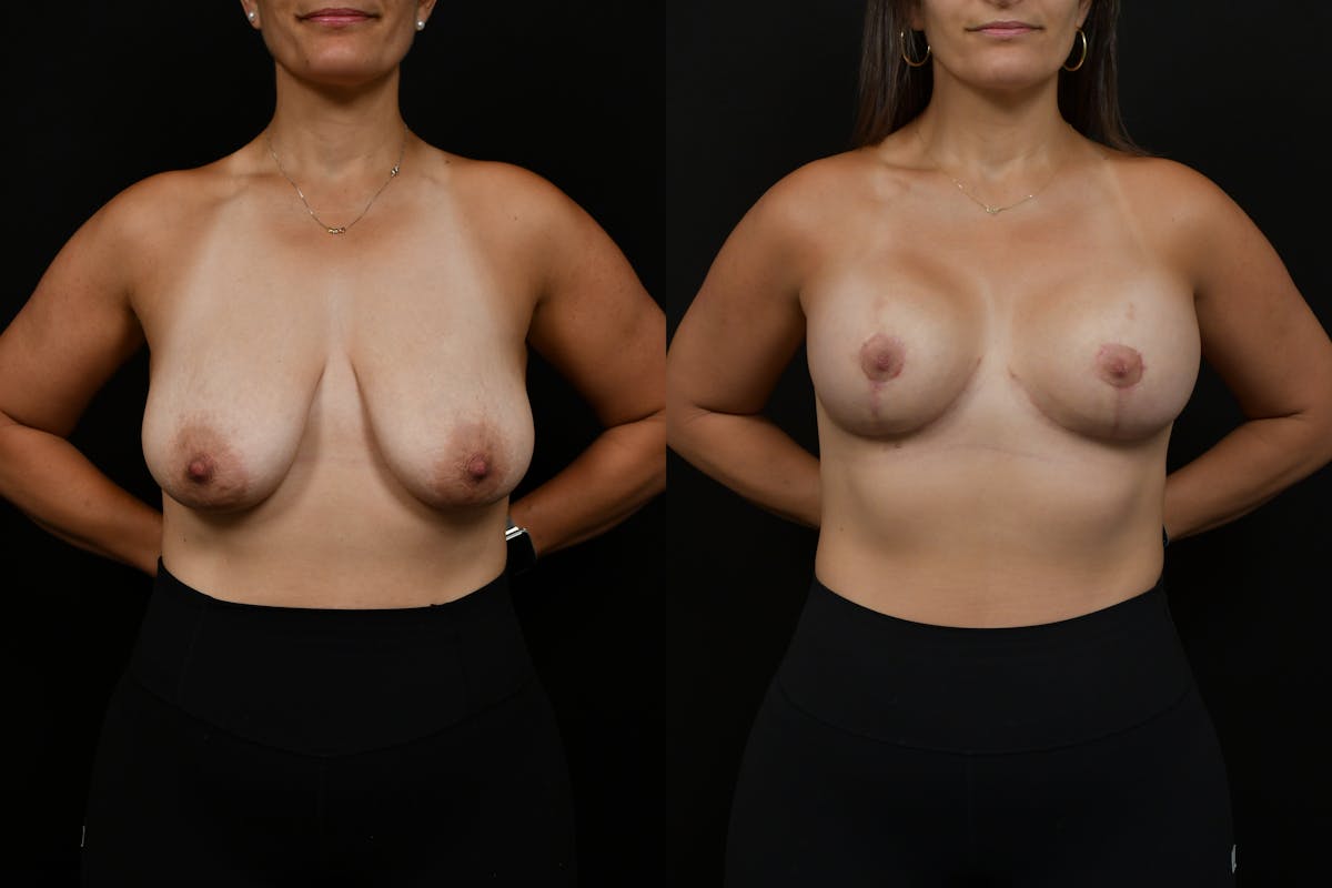 Breast Lift Before & After Gallery - Patient 182455 - Image 1