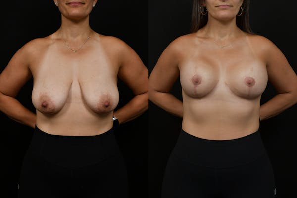 Breast Augmentation Before & After Gallery - Patient 131687 - Image 1