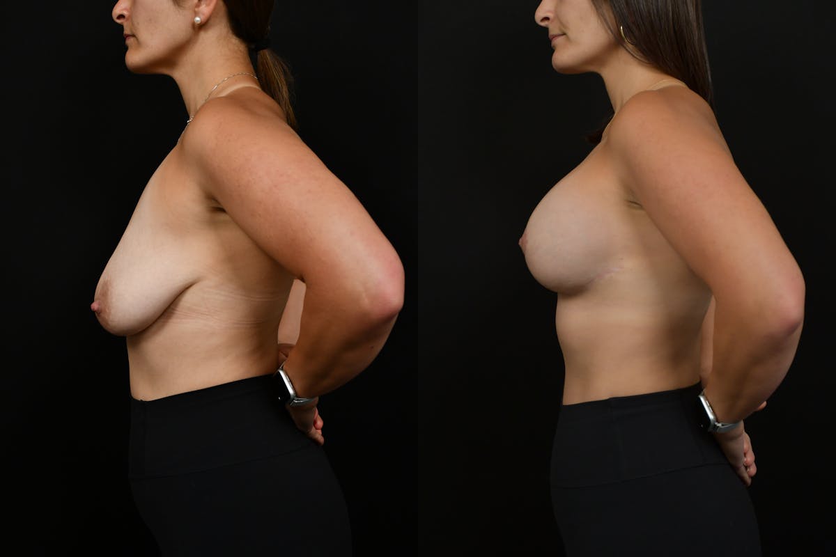 Breast Lift Before & After Gallery - Patient 182455 - Image 5