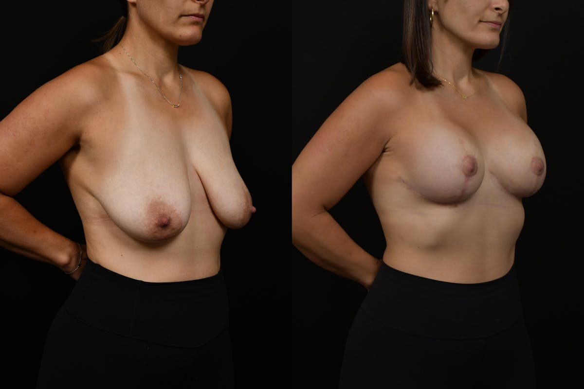 Breast Lift Before & After Gallery - Patient 182455 - Image 2