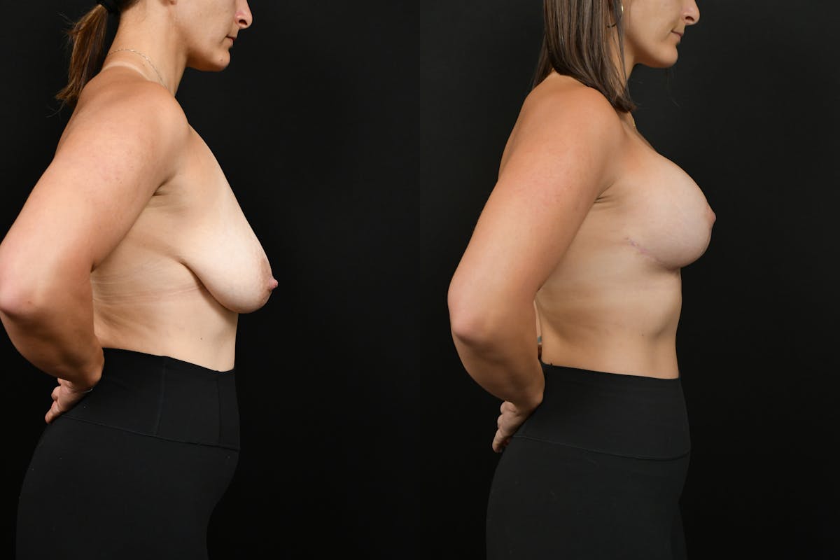 Breast Lift Before & After Gallery - Patient 182455 - Image 3