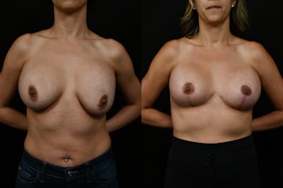 Reductive Augmentation Before & After Gallery - Patient 150789 - Image 1