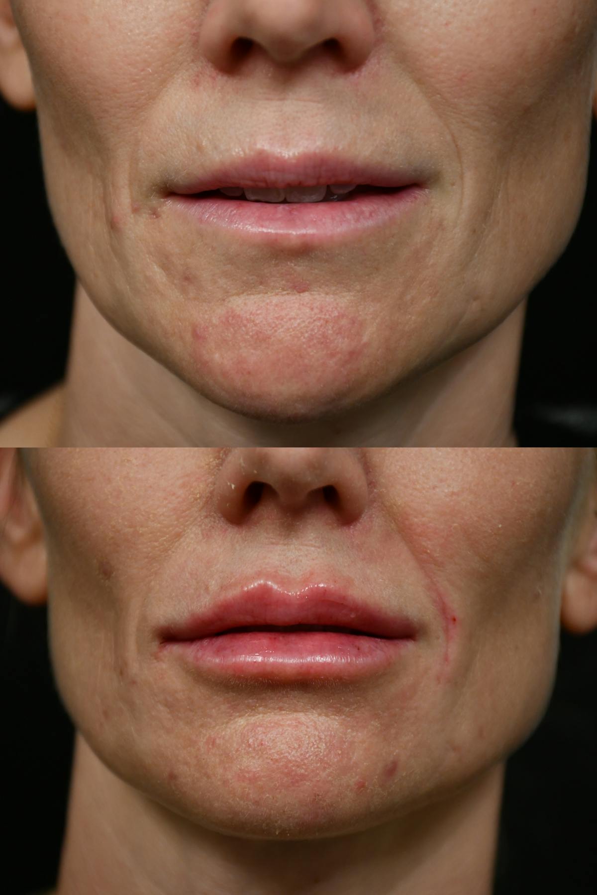 Lips Before & After Gallery - Patient 940227 - Image 1