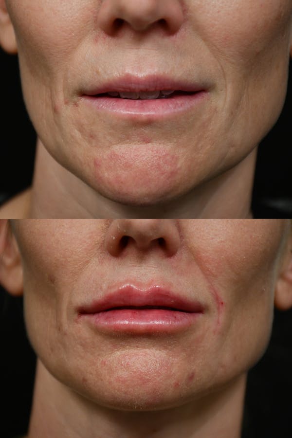 Injectables Before & After Gallery - Patient 177889 - Image 1