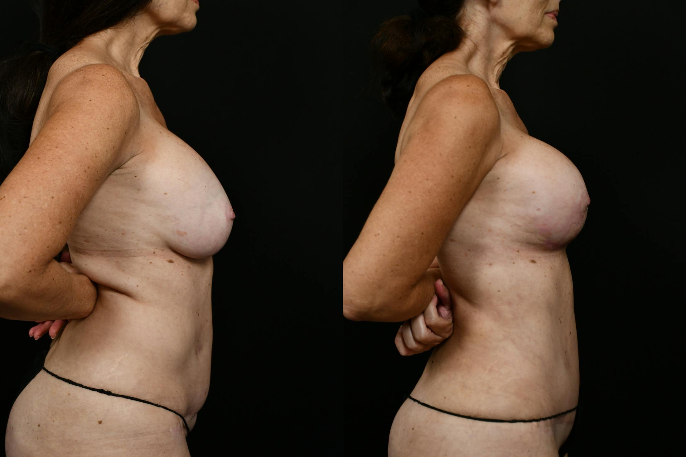 Reductive Augmentation Before & After Gallery - Patient 106784 - Image 3