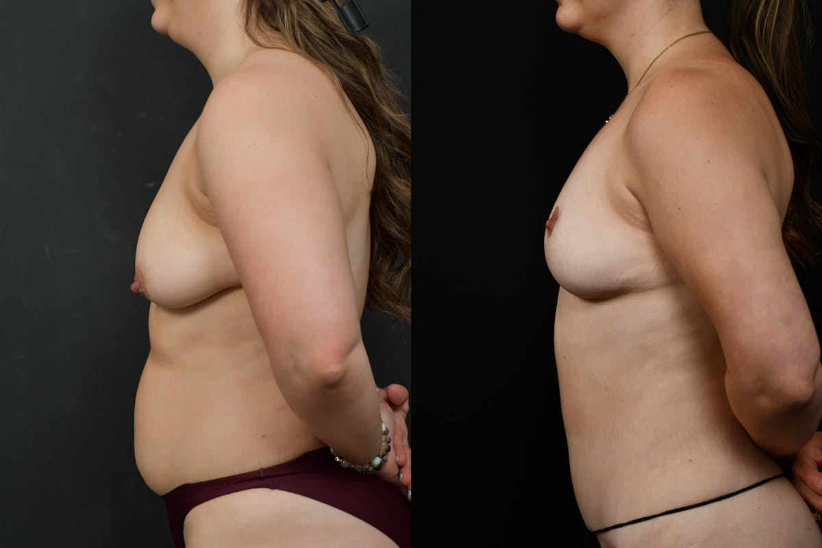 Breast Lift Before & After Gallery - Patient 379193 - Image 3