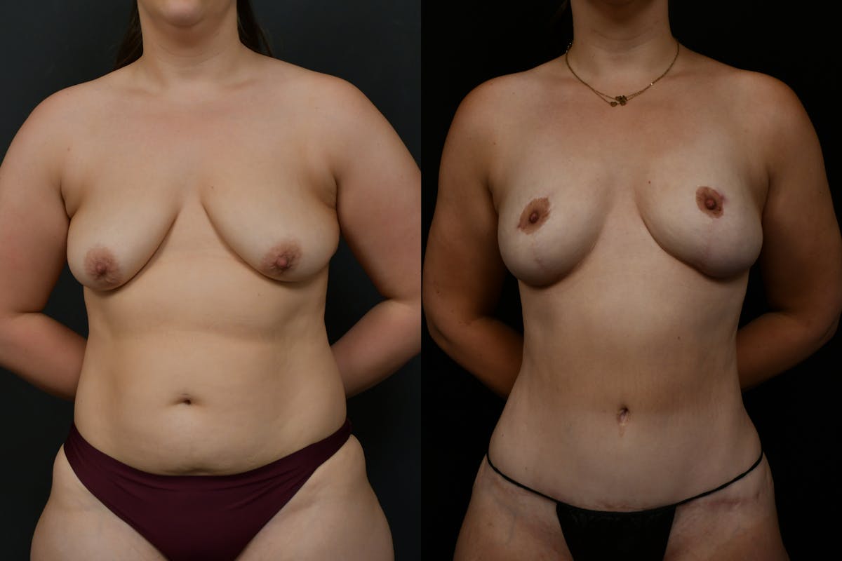 Breast Lift Before & After Gallery - Patient 379193 - Image 1