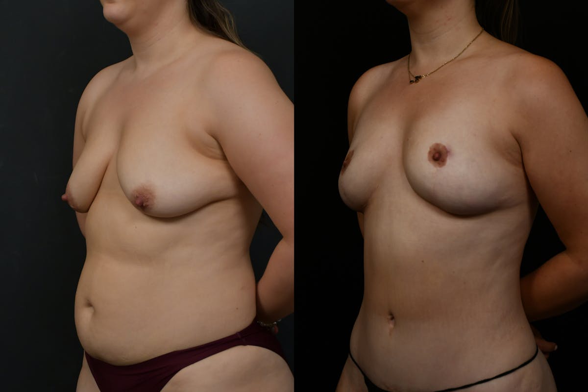 Breast Lift Before & After Gallery - Patient 379193 - Image 2