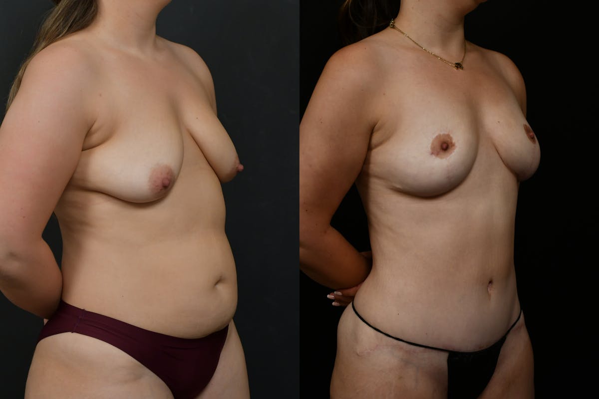 Breast Lift Before & After Gallery - Patient 379193 - Image 4