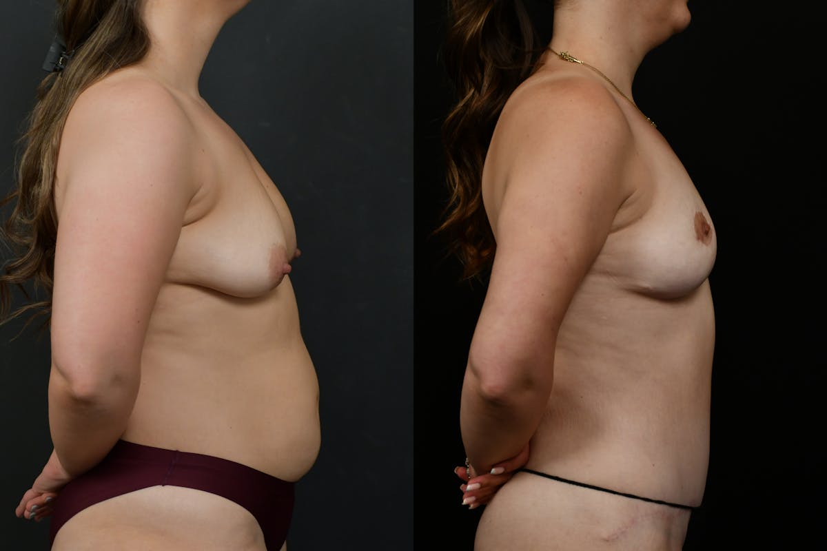 Breast Lift Before & After Gallery - Patient 379193 - Image 5